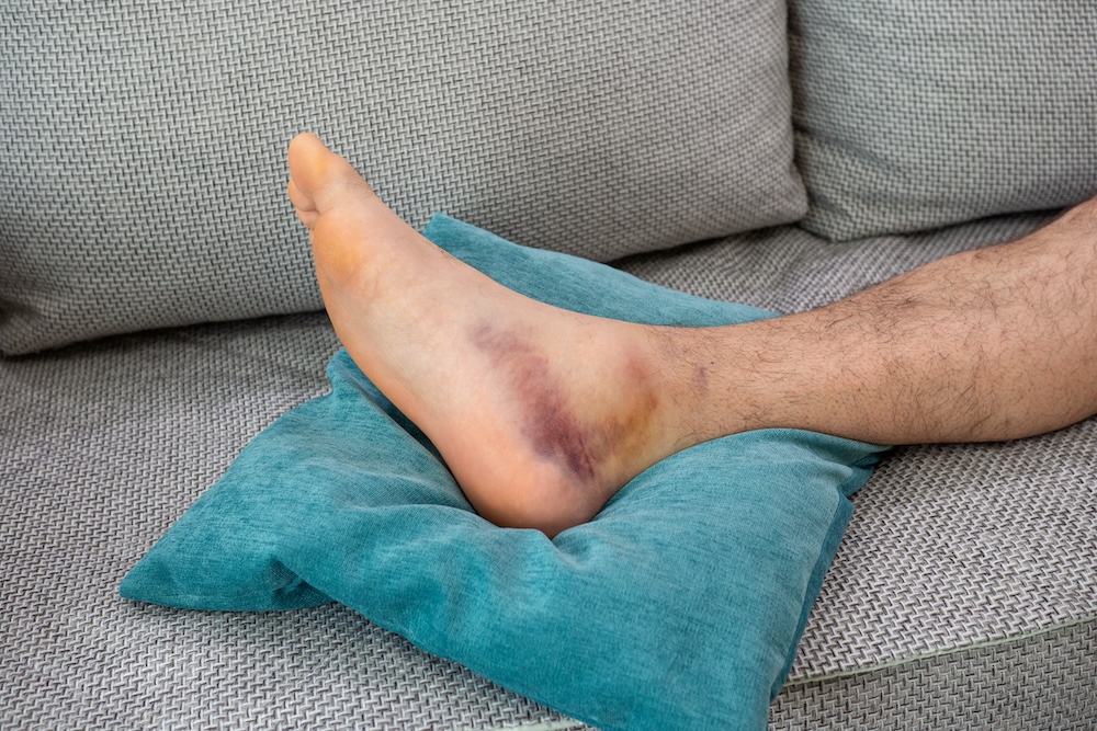 A broken or sprained ankle with bruising and swelling propped up on a pillow