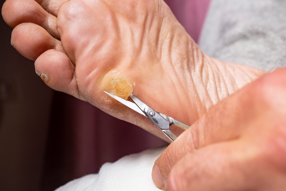 a podiatrist for diabetic foot pain treatment performs a callus removal to reduce pressure during a diabetic foot exam