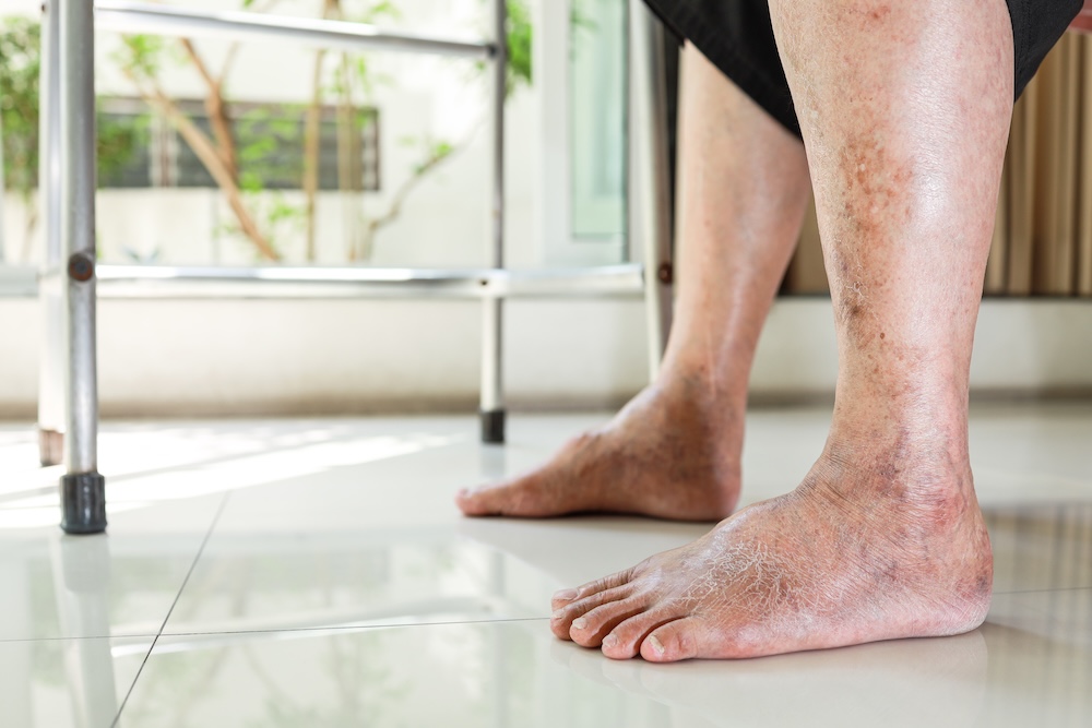 a geriatric podiatry patient feeling unstable on feet using a walker to help with with foot instability