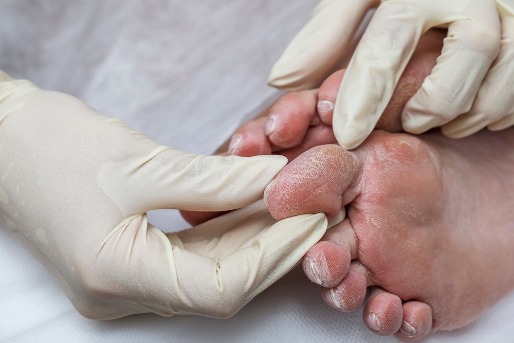 diabetic foot dry and cracked (2).jpg