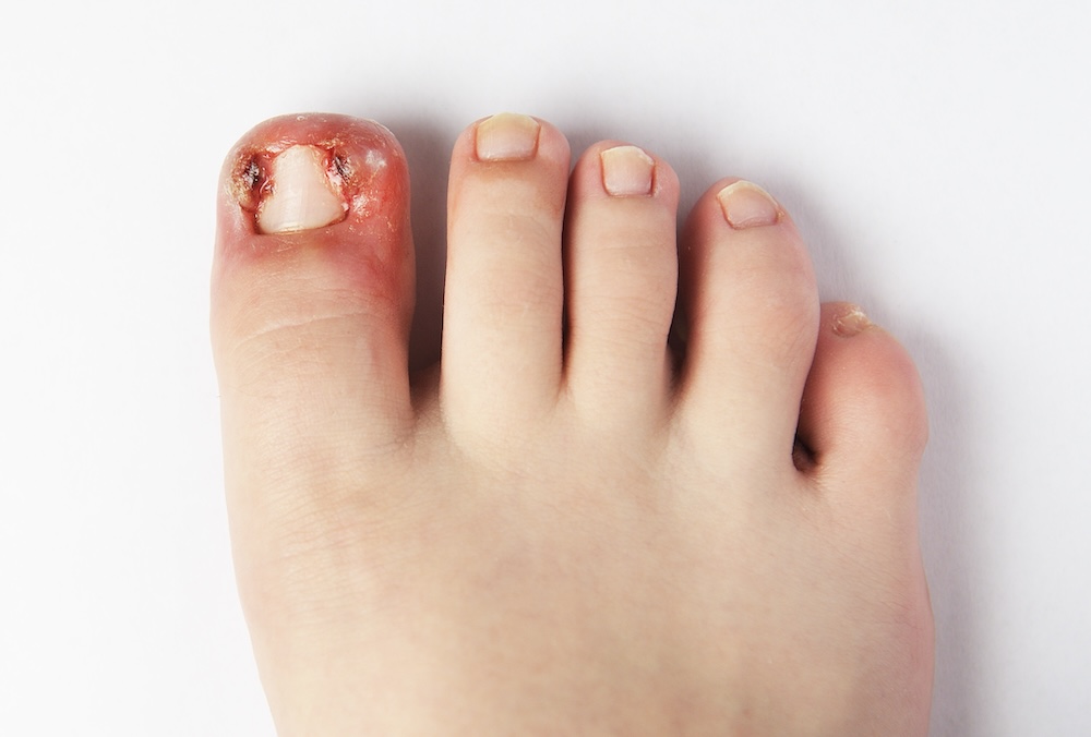 nasty ingrown toenail.jpg
