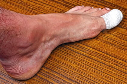 Ingrown Toenails Treatment | Foot Doctor, Certified Pedorthist South  Carolina