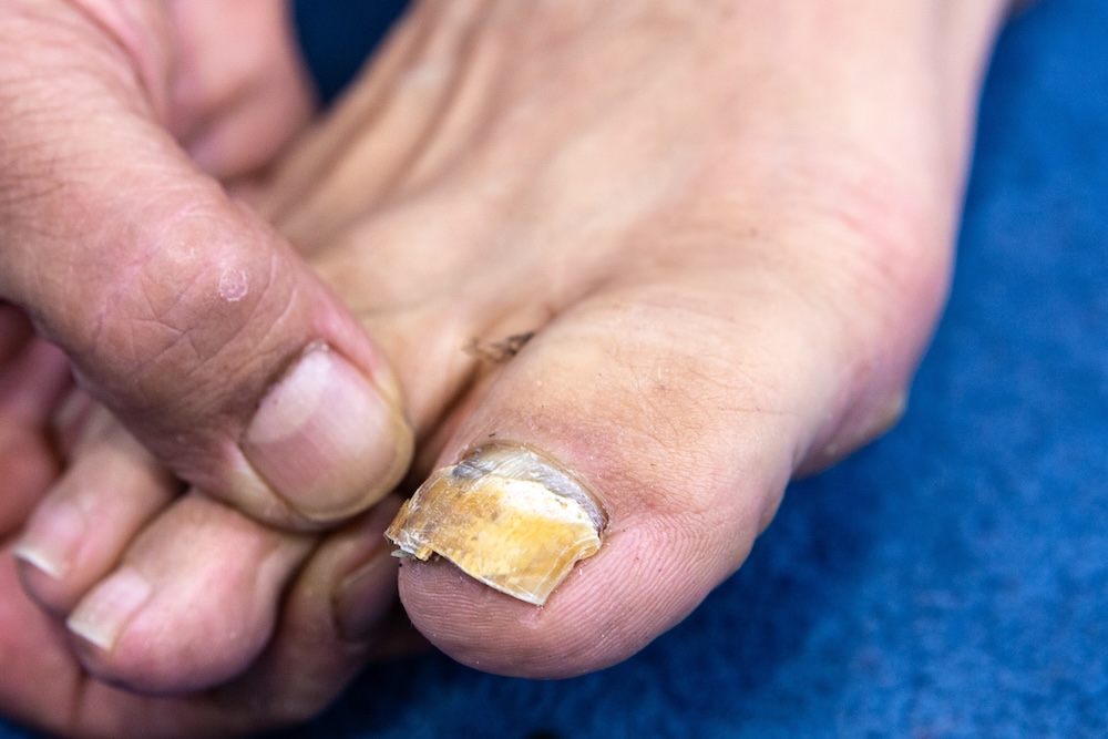 a podiatrist for diabetic foot care performs a diabetic foot exam on a patient with severe fungal toenails