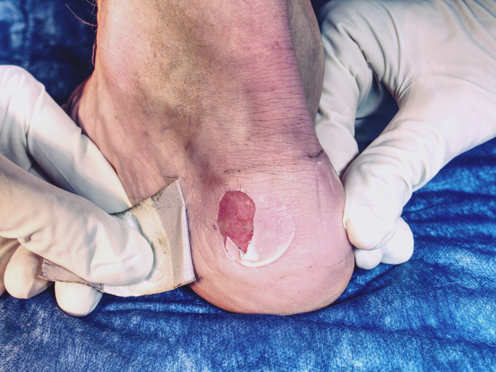 a podiatrist for diabetic foot care examines a blister on a patient's heel