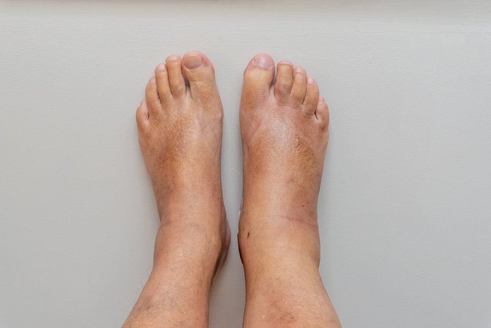 swollen feet comparison to regular, non-swollen foot, showing visible puffiness 
