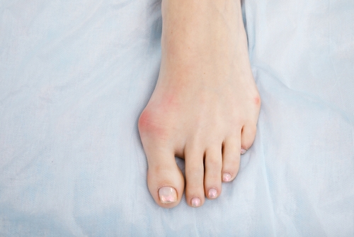 bunions