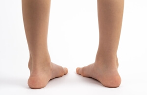 Causes, Symptoms, and Supportive Solutions for Flat Feet
