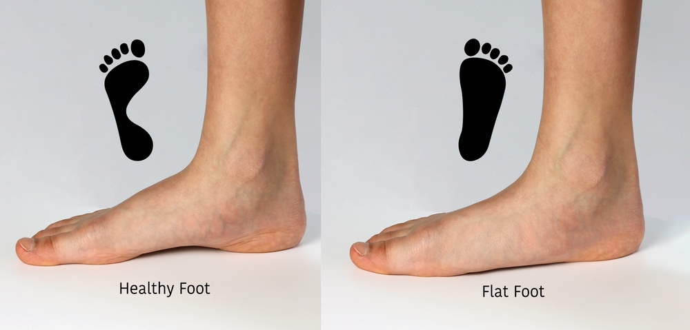 Pediatric Flat Feet: Symptoms, Causes, and Treatment Options