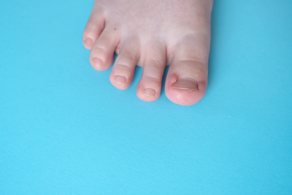 Pediatric Ingrown Toenail Symptoms Parents Shouldn’t Ignore