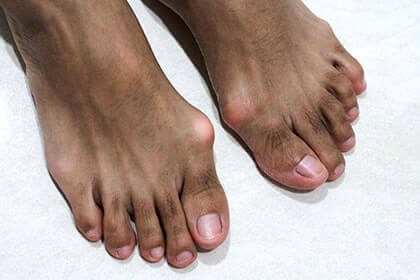Bunions treatment and surgery in the Aiken, SC 2980, Beaufort, SC 29902, Cayce, SC 29033, Columbia, SC 29204 and 29203, Florence, SC 29501, Hartsville, SC 29550, Hinesville, GA 31313, Mount Pleasant, SC 29464, Newberry, SC 29108, North Charleston, SC 29418, Orangeburg, SC 29115, Savannah, GA 31405, Summerville, SC 29486, Sumter, SC 29150, and Charleston, SC 29414 areas