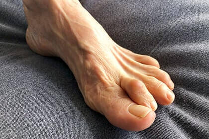 Hammertoe and mallet toe treatment in the Aiken, SC 2980, Beaufort, SC 29902, Cayce, SC 29033, Columbia, SC 29204 and 29203, Florence, SC 29501, Hartsville, SC 29550, Hinesville, GA 31313, Mount Pleasant, SC 29464, Newberry, SC 29108, North Charleston, SC 29418, Orangeburg, SC 29115, Savannah, GA 31405, Summerville, SC 29486, Sumter, SC 29150, and Charleston, SC 29414 areas
