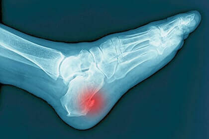 Heel spurs specialist in the Aiken, SC 2980, Beaufort, SC 29902, Cayce, SC 29033, Columbia, SC 29204 and 29203, Florence, SC 29501, Hartsville, SC 29550, Hinesville, GA 31313, Mount Pleasant, SC 29464, Newberry, SC 29108, North Charleston, SC 29418, Orangeburg, SC 29115, Savannah, GA 31405, Summerville, SC 29486, Sumter, SC 29150, and Charleston, SC 29414 areas