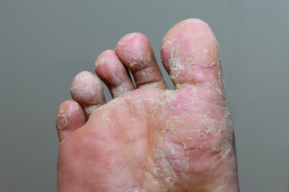 athletes foot picture, with treatment offered by Physicians Footcare podiatry practice in South Carolina, Georgia, and across the Southeast
