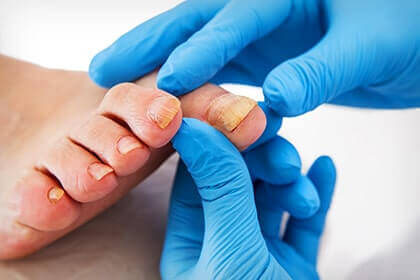 Toenail Fungus Treatment in South Carolina & Georgia