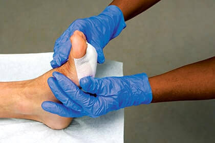 Diabetic Ulcers Treatment in the Aiken, SC 2980, Beaufort, SC 29902, Cayce, SC 29033, Columbia, SC 29204 and 29203, Florence, SC 29501, Hartsville, SC 29550, Hinesville, GA 31313, Mount Pleasant, SC 29464, Newberry, SC 29108, North Charleston, SC 29418, Orangeburg, SC 29115, Savannah, GA 31405, Summerville, SC 29486, Sumter, SC 29150, and Charleston, SC 29414 areas